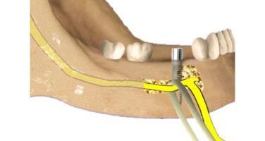 Alt çene sinirinin , yana  kaydýrýlarak implant uygulanmasý