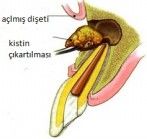 Apikal rezeksiyon nedir ? , kist operasyonu diþ