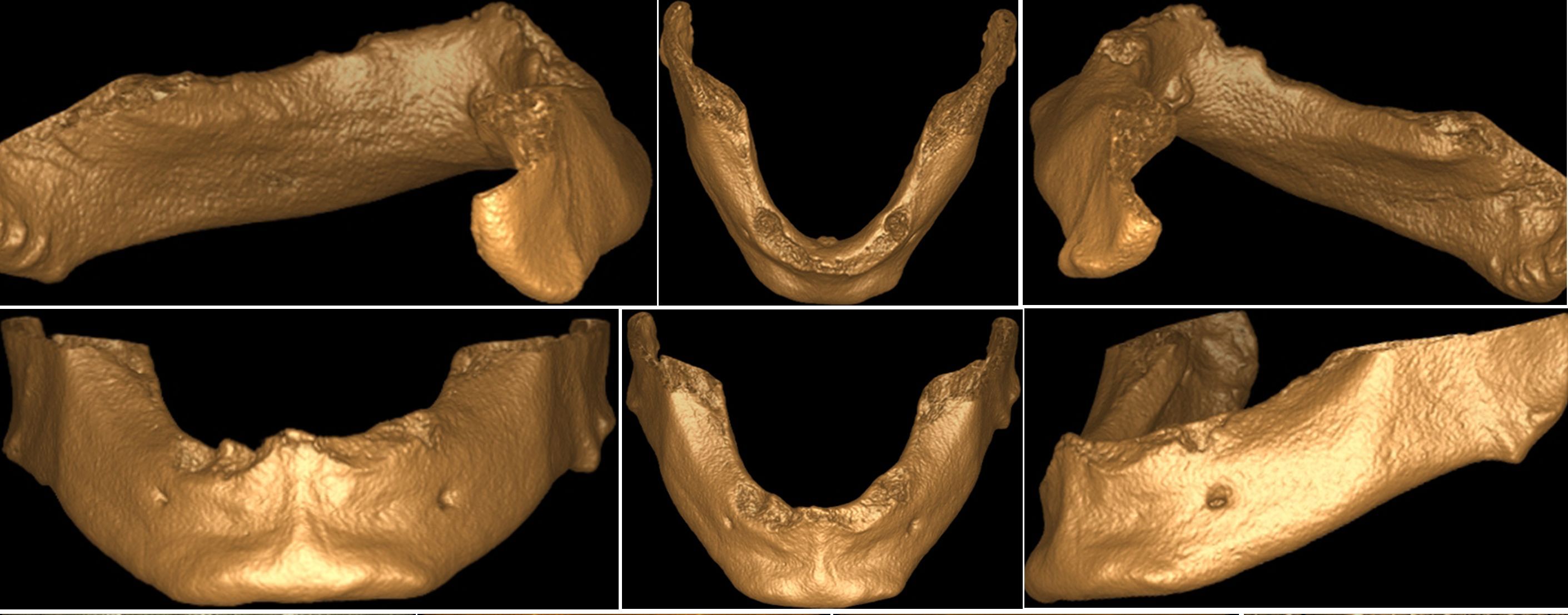 Dental Volumetrik Tomografi