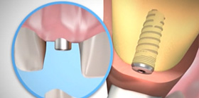 Ýmplant Diþ Ameliyatý Nasýl Yapýlýr?