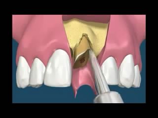Ýmmediyat Ýmplant ; Diþi çeker çekmez implant tedavisi