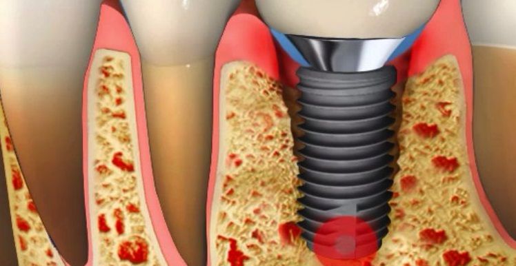 PERÝ ÝMPLANTÝTÝS ; implant çevresindeki dokunun  iltihaplanmasý