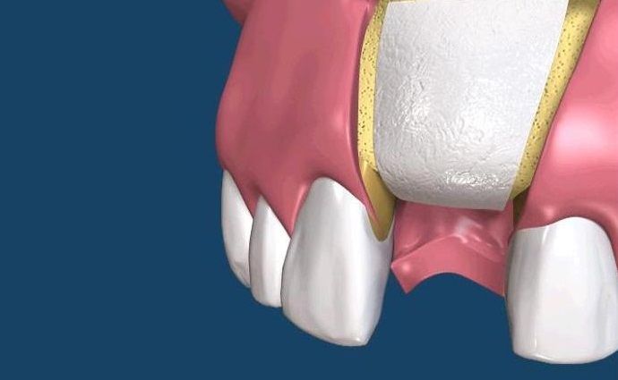 Çene kemiði erimesi tedavisi