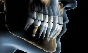 Ýmplant Nedir ? Ýmplant Diþ Nedir ?