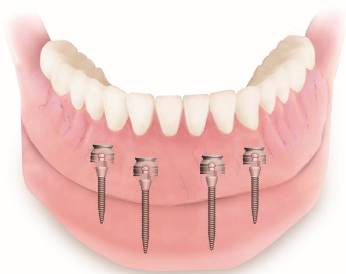 Mini Ýmplant Nasýl Yapýlýr ?