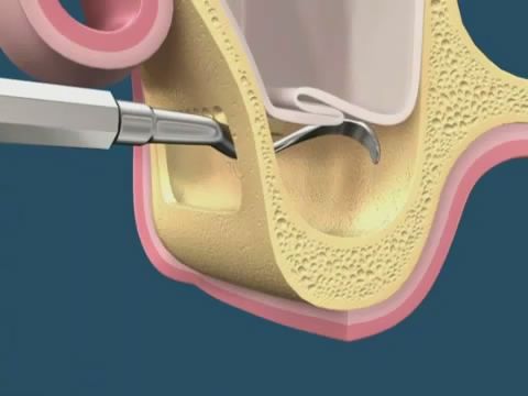 Sinüs Lifting Ameliyatý ( Açýk Teknik )